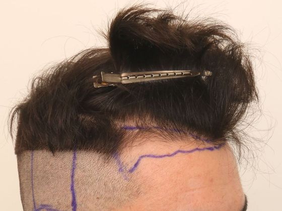 Male Before And After Hair Transplant Photos Hairline FUE (5) - Before