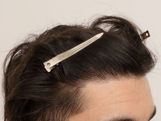 Male Before And After Hair Transplant Photos Hairline FUE (5) - After