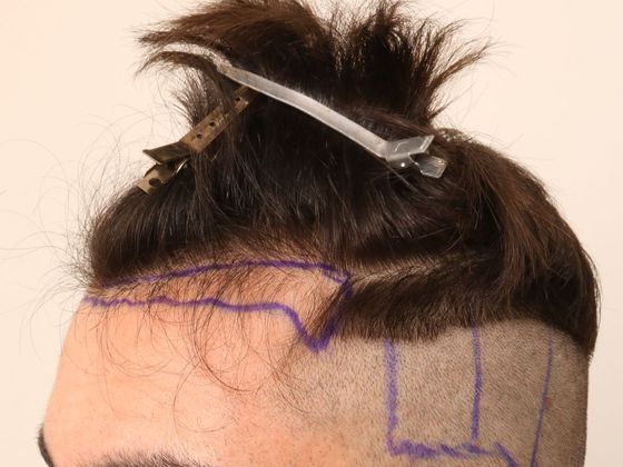 Hair Transplant - Male: Hairline FUE - Case 5 - Before FUE hair transplant