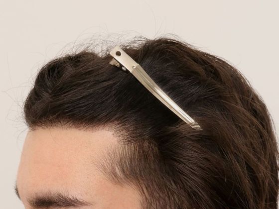 Hair Transplant - Male: Hairline FUE - Case 5 - After FUE hair transplant