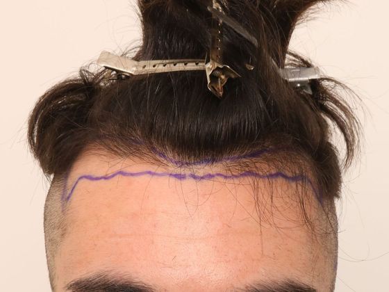 Hair Transplant - Male: Hairline FUE - Case 5 - Before FUE hair transplant