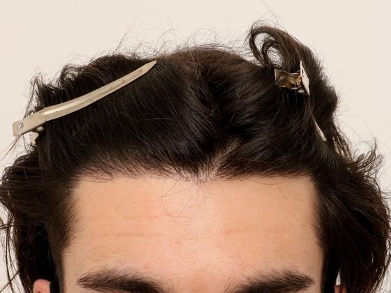 Hair Transplant - Male: Hairline FUE - Case 5 - After FUE hair transplant