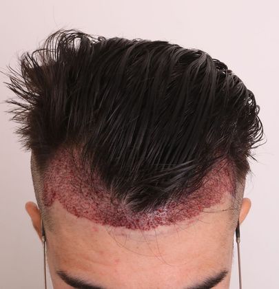 Hair Transplant - Male: Hairline FUE - Case 5 - Post-op FUE hair transplant