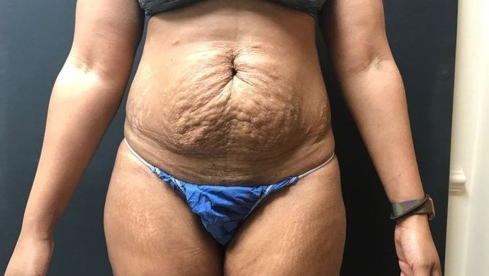 Abdominoplasty Case 23 - Before