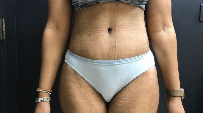 Abdominoplasty Case 23 - After