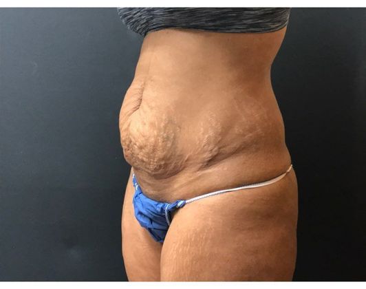 Abdominoplasty: Case 23 - Before