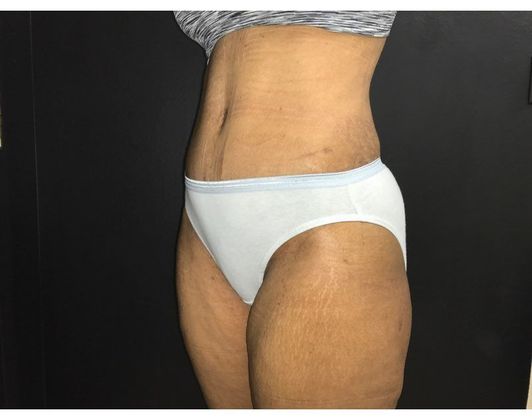Abdominoplasty: Case 23 - After