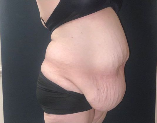 Abdominoplasty Case 24 - Before