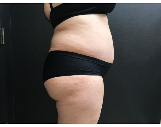 Abdominoplasty Case 24 - After