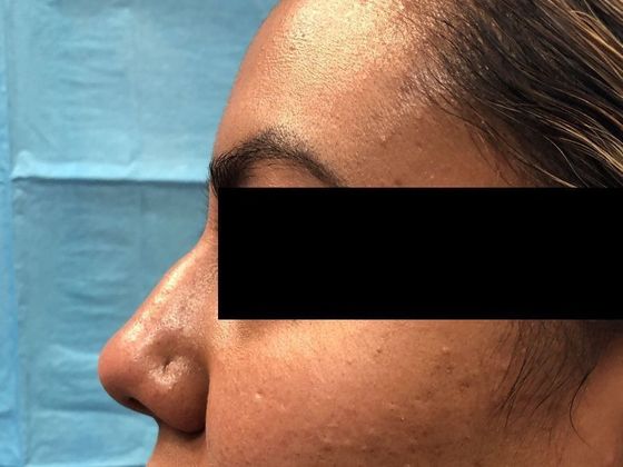 Cosmetic Injectables & Fillers*: Case 28 Non-Surgical Rhinoplasty - Before