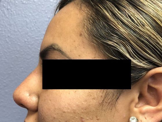 Cosmetic Injectables & Fillers*: Case 28 Non-Surgical Rhinoplasty - After