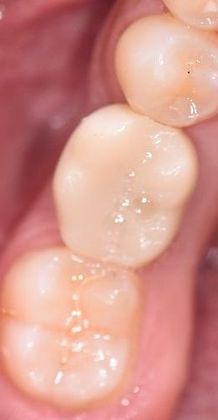 Dental Implants: Case 11 - Edna, TX - After