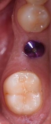 Dental Implants: Case 11 - Edna, TX - Before