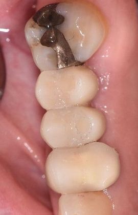 Dental Implants Case 12 - Port O