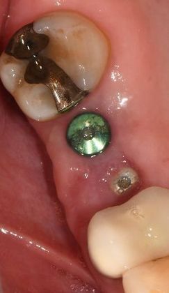 Dental Implants Case 12 - Port O