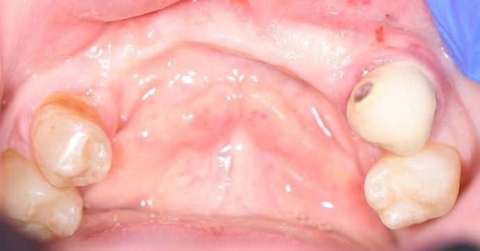 Dental Implants Case 13 - Houston, TX - Before