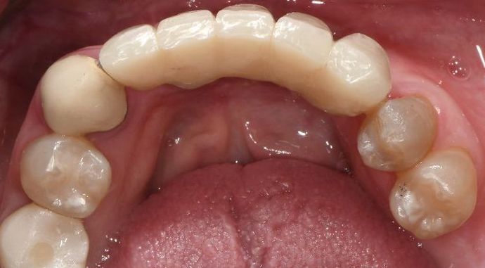 Dental Implants Case 13 - Houston, TX - After