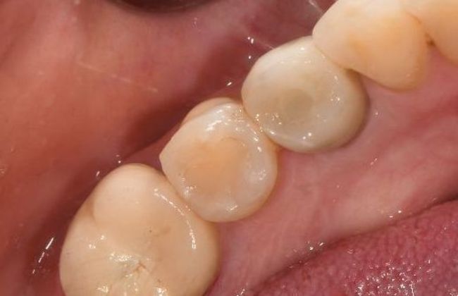 Dental Implants: Case 14 - Victoria, TX - After