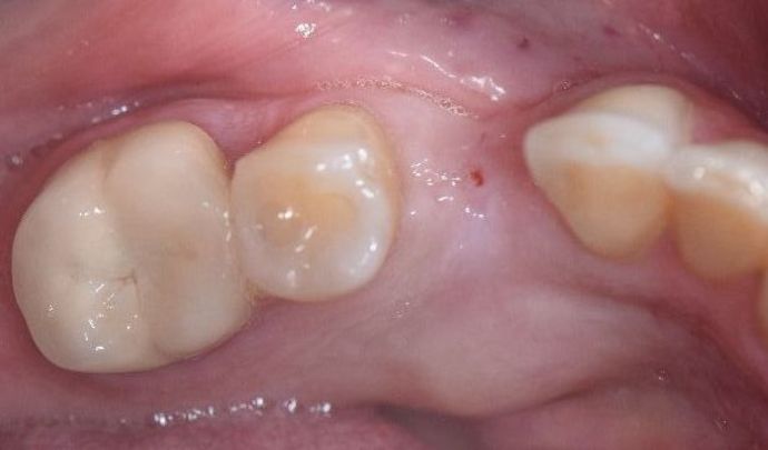Dental Implants: Case 14 - Victoria, TX - Before