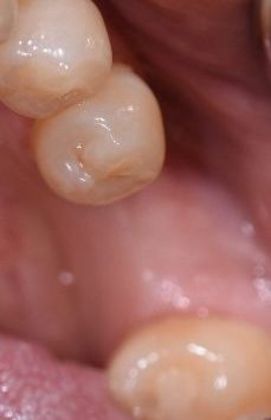 Dental Implants Case 15 - Victoria, TX - Before