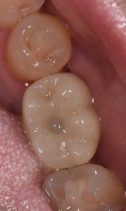 Dental Implants Case 15 - Victoria, TX - After