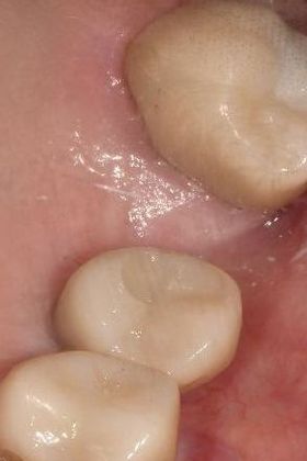 Dental Implants: Case 16 - Victoria, TX - After