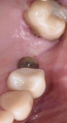 Dental Implants: Case 16 - Victoria, TX - Before