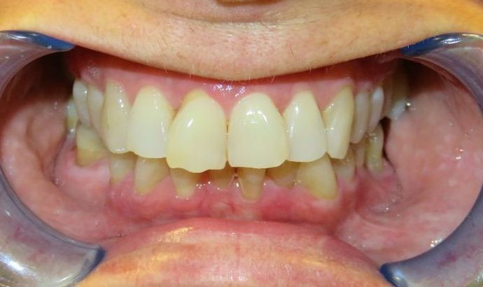 Dental Implants Case 5 - Before