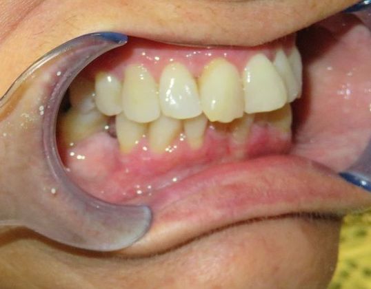 Dental Implants: Case 5 - Before