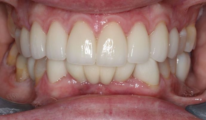 Dental Implants Case 5 - After