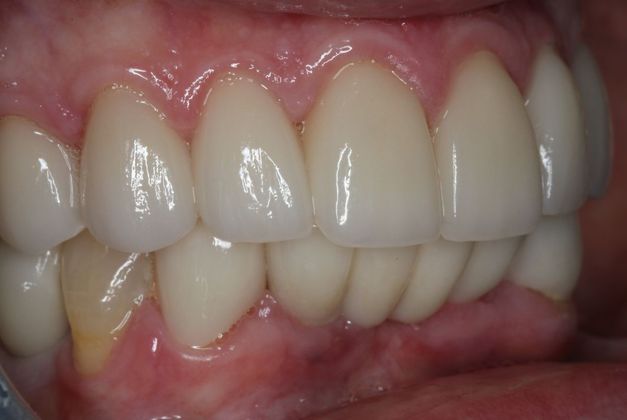 Dental Implants: Case 5 - After