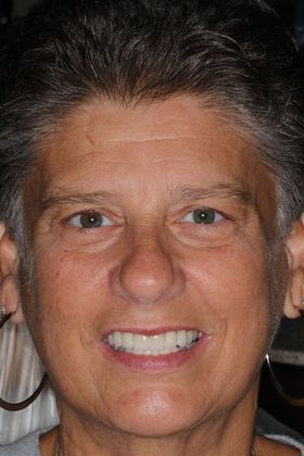 Dental Crowns Case 30 - After