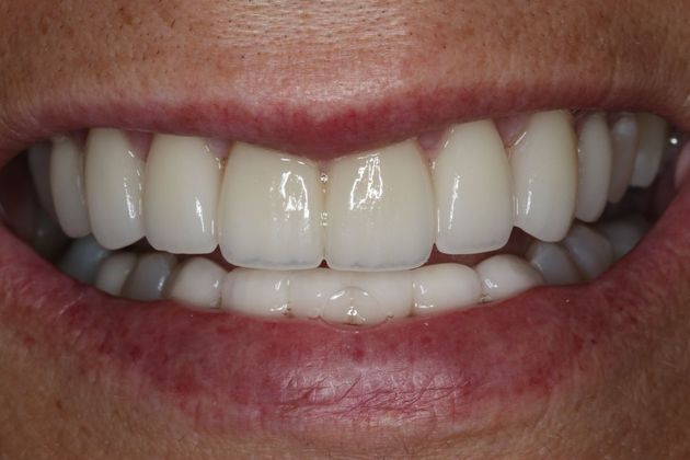 Dental Crowns: Case 30 - After