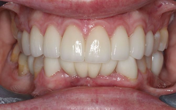 Dental Crowns: Case 30 - After