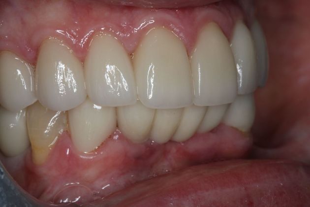 Dental Crowns: Case 30 - After