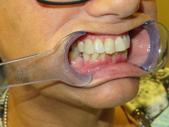 Dental Crowns: Case 30 - Before