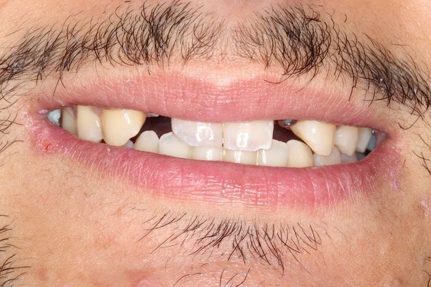 Dental Implants Case 6 - Before