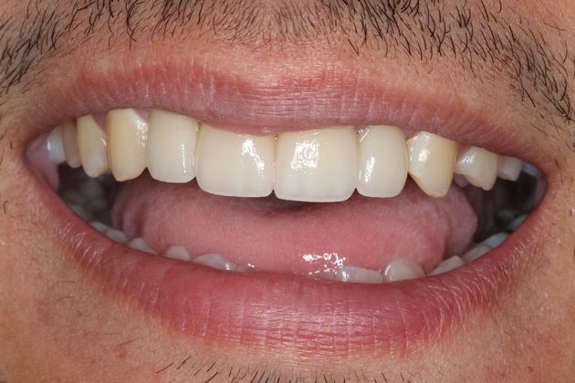 Dental Implants Case 6 - After