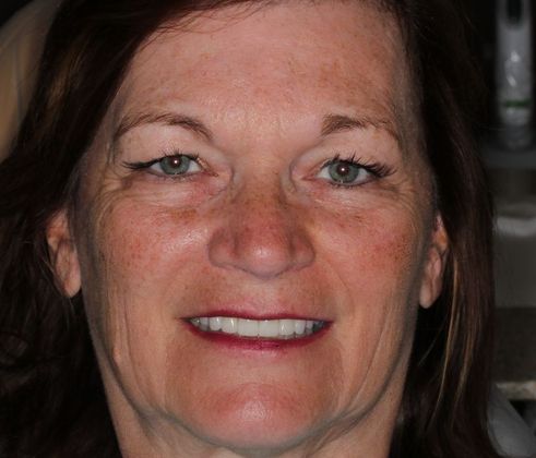 Veneers: Case 6 - After