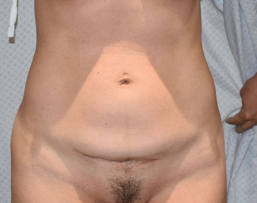 Tummy Tuck (Abdominoplasty): Case 294 - Before