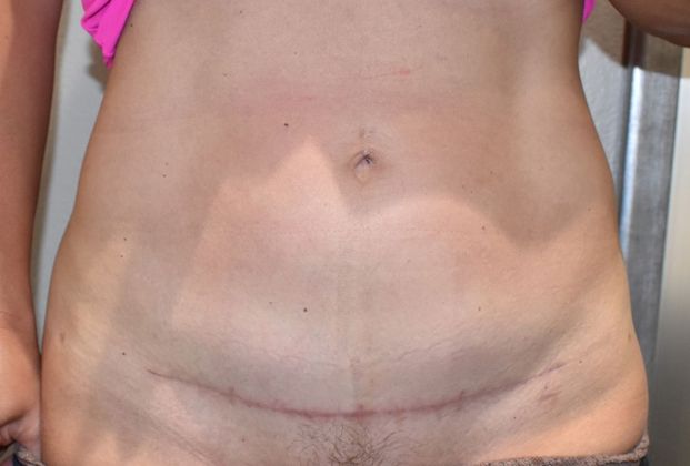 Tummy Tuck (Abdominoplasty): Case 294 - After