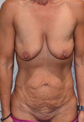 Mommy Makeover Case 193 - Before