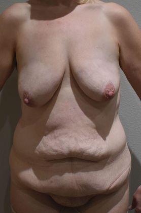 Mommy Makeover Case 194 - Before