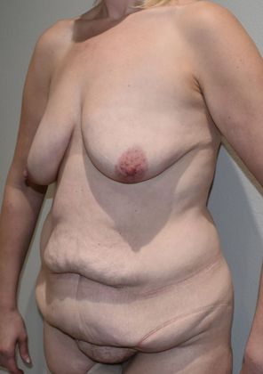 Massive Weight Loss : Case 84 - Before