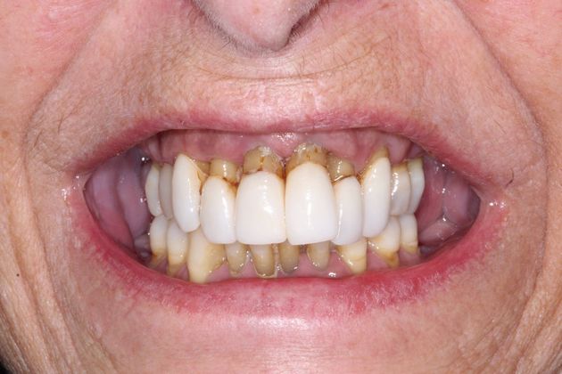 Dental Works implant patient before treatment