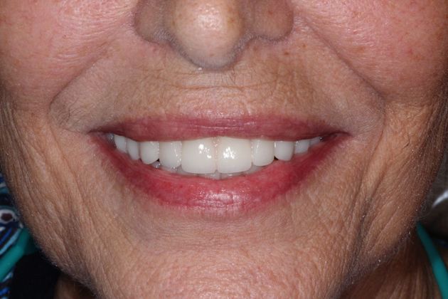 Dental Works implant patient after treatment