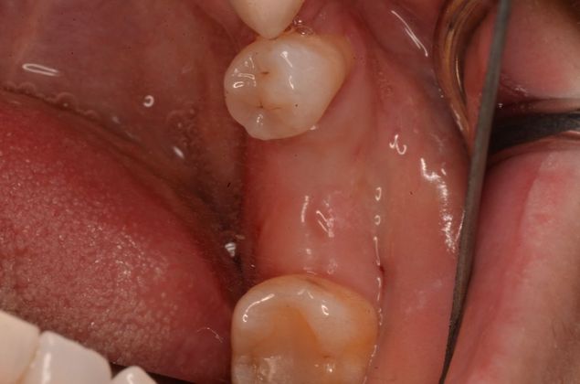 Dental Implants: Case 51 - After extraction but before dental implant