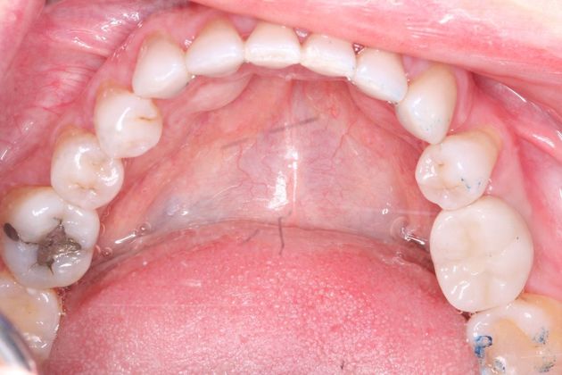 Dental Implants: Case 51 - After implant and crown