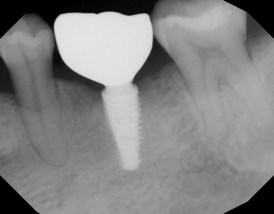 Dental Implants: Case 51 - After implant (radiograph)