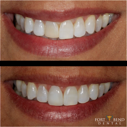 Single Veneer On Front Tooth Veneers Before And After Gallery